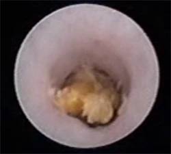 лазерная литотрипсия