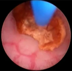 Подведение дистального торца волокна к поверхности камня
