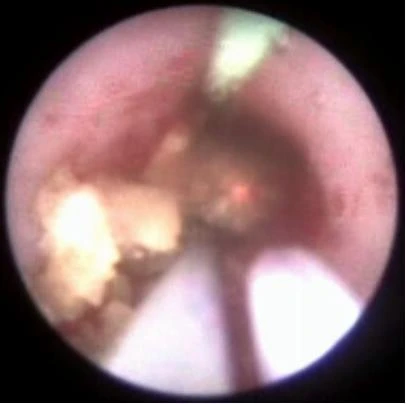 Процесс фрагментации камня